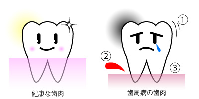 歯周病シェーマ