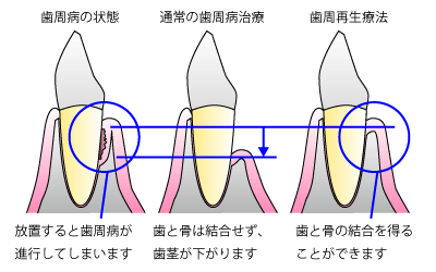 再生療法