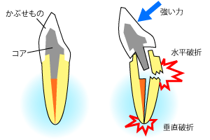 歯根破折